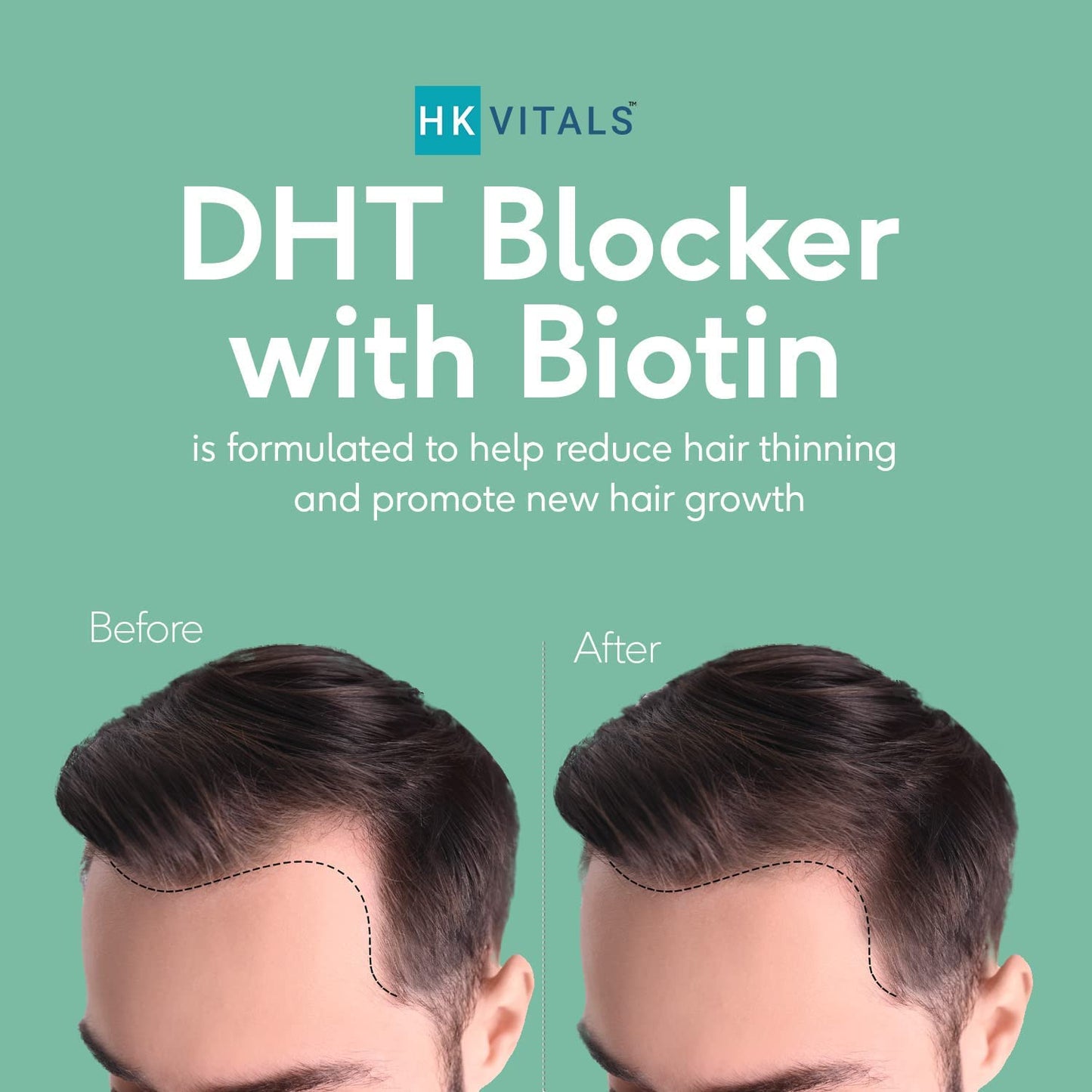 Glamzy HK Vitals DHT Blocker with Biotin, Stinging Nettle and SOYA Protein, Helps Reduce Hair Fall, Stimulates Hair Growth, 60 Tablets