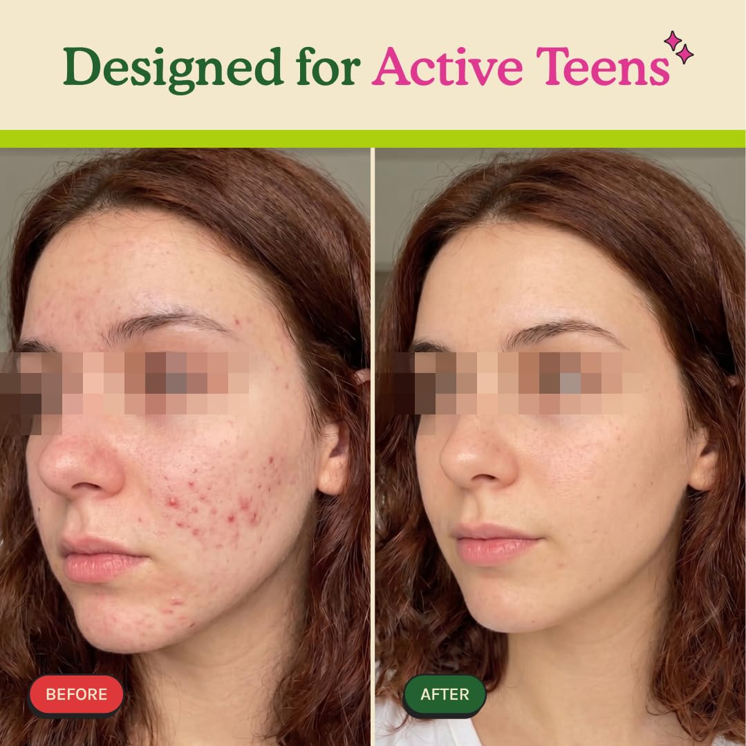 NURISR Acne Support Multivitamin for Teens with Vitamins A, B, C, E & Biotin, 1 Tablet
