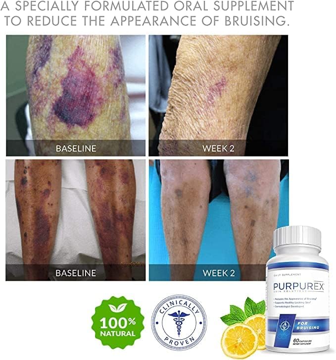 PURPUREX Dietary Supplement for Bruising Capsule 1