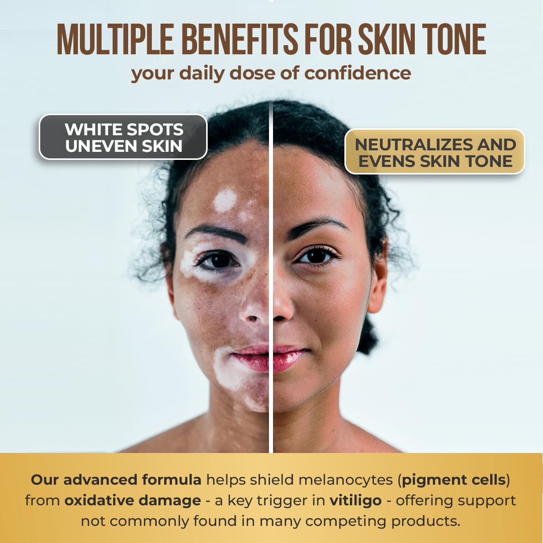 Aura Vitamins Dermawonder Vitiligo Capsules, 60 Capsules