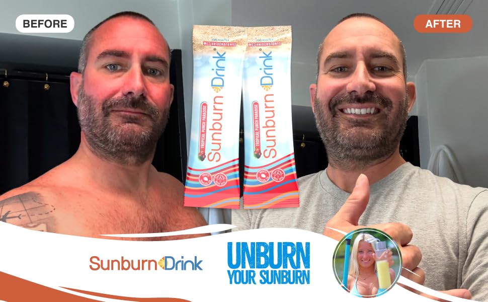 Sunburn Drink Sunburn Relief Drink Tropical Punch Paradise Powder Pack of 20