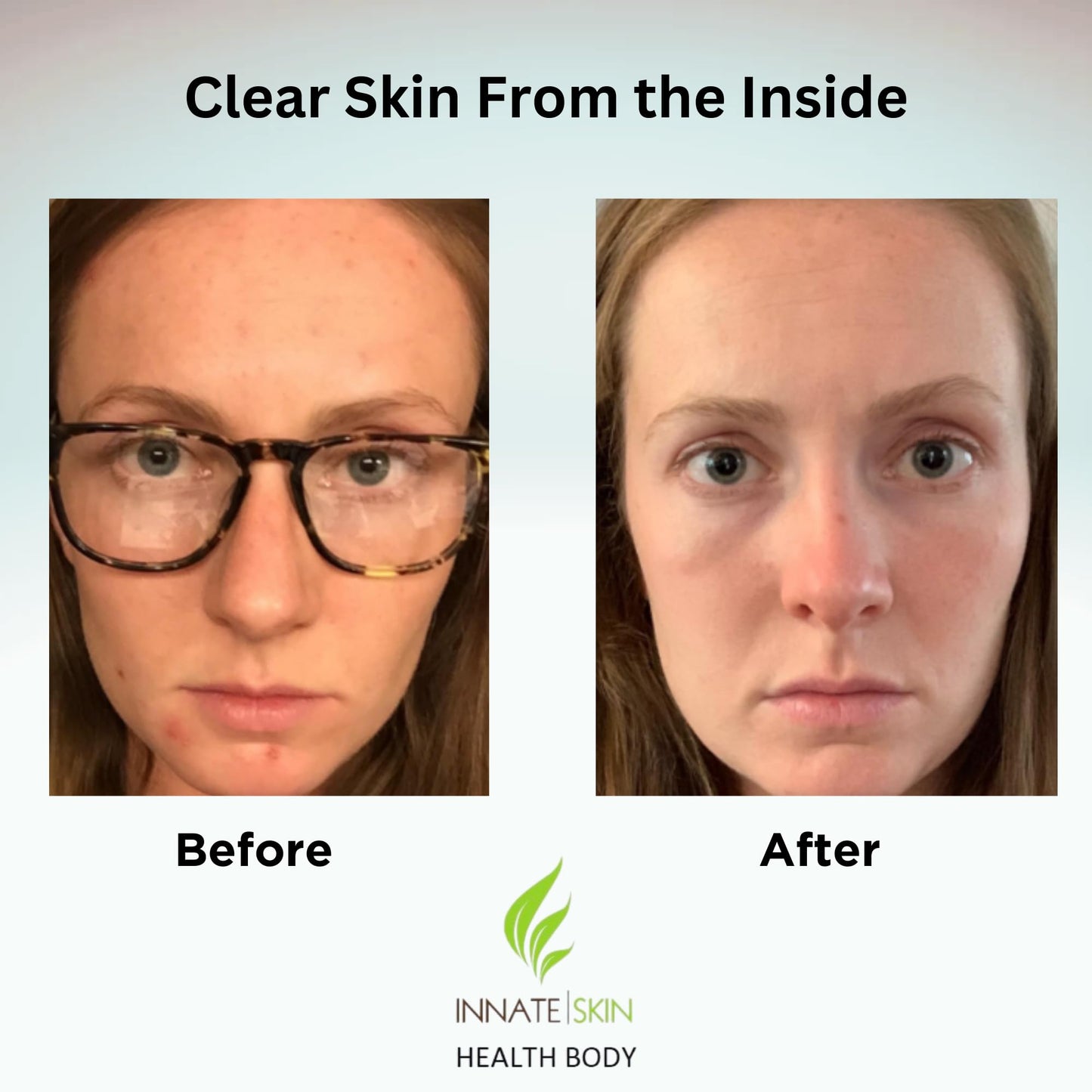 Innate Skin Clear Skin Acne Vitamin System Capsules 120 Count