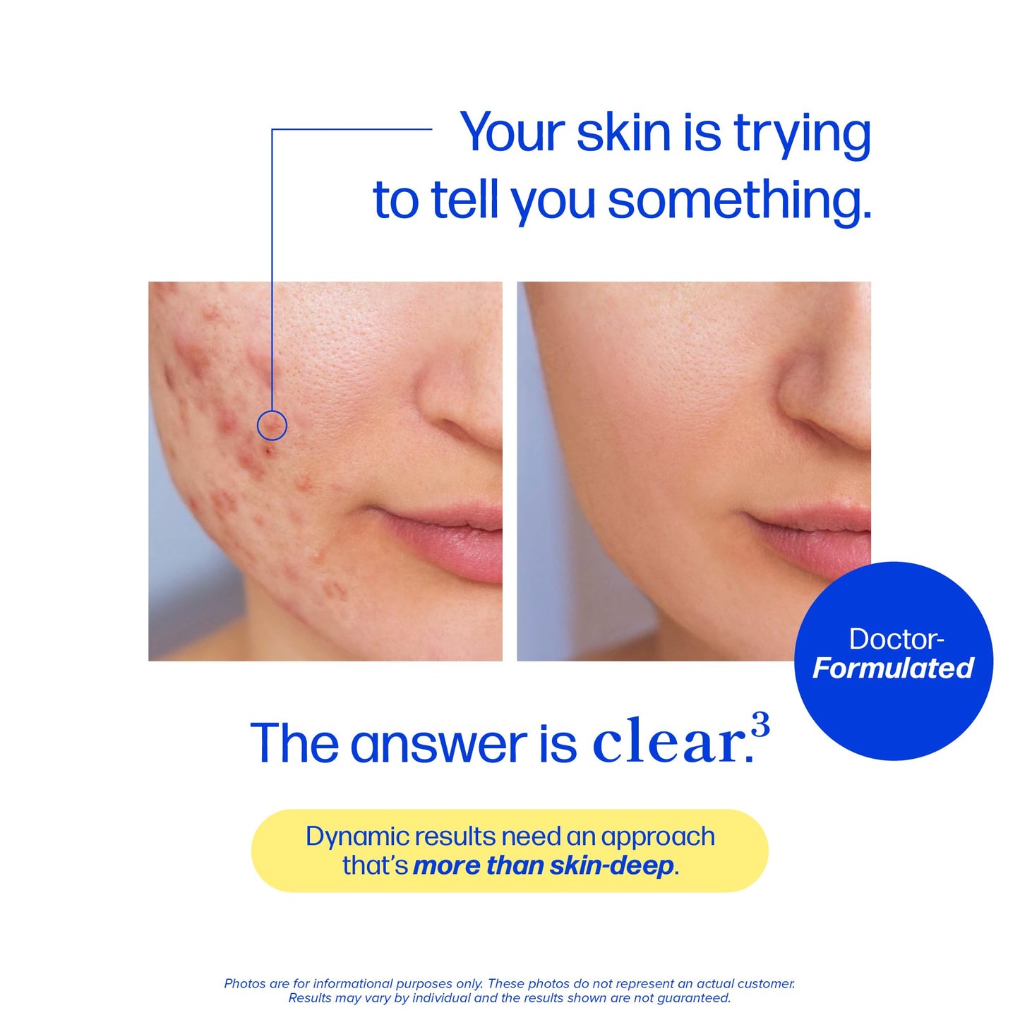 SMNutrition Clear Skin Supplement Acne Support, Zinc DIM, Probiotics, Doctor-Formulated Capsule, 60 Count