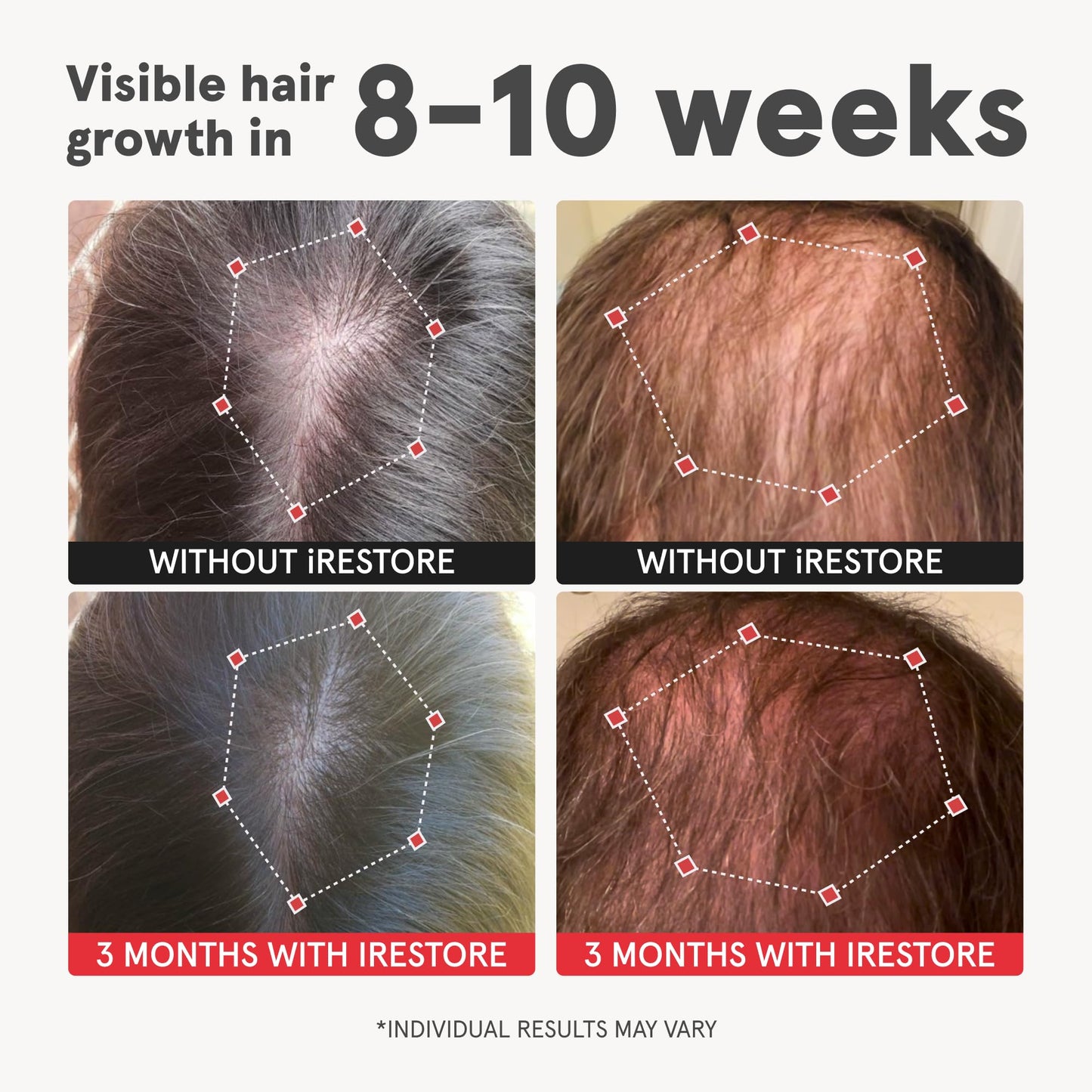 iRestore Advanced Hair Growth Supplement Capsule 120 Count